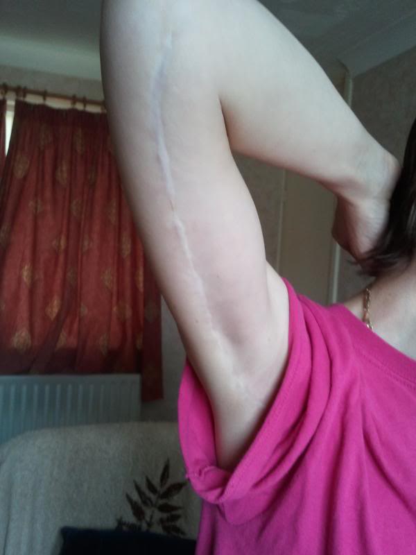18thJune2014-Rightarm_zps55799282.jpg