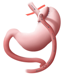 Gastric Bypass
