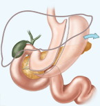Gastric Sleeve