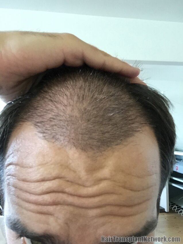 - Member Albums - Hair Restoration Network - Forum For and By Hair Loss ...