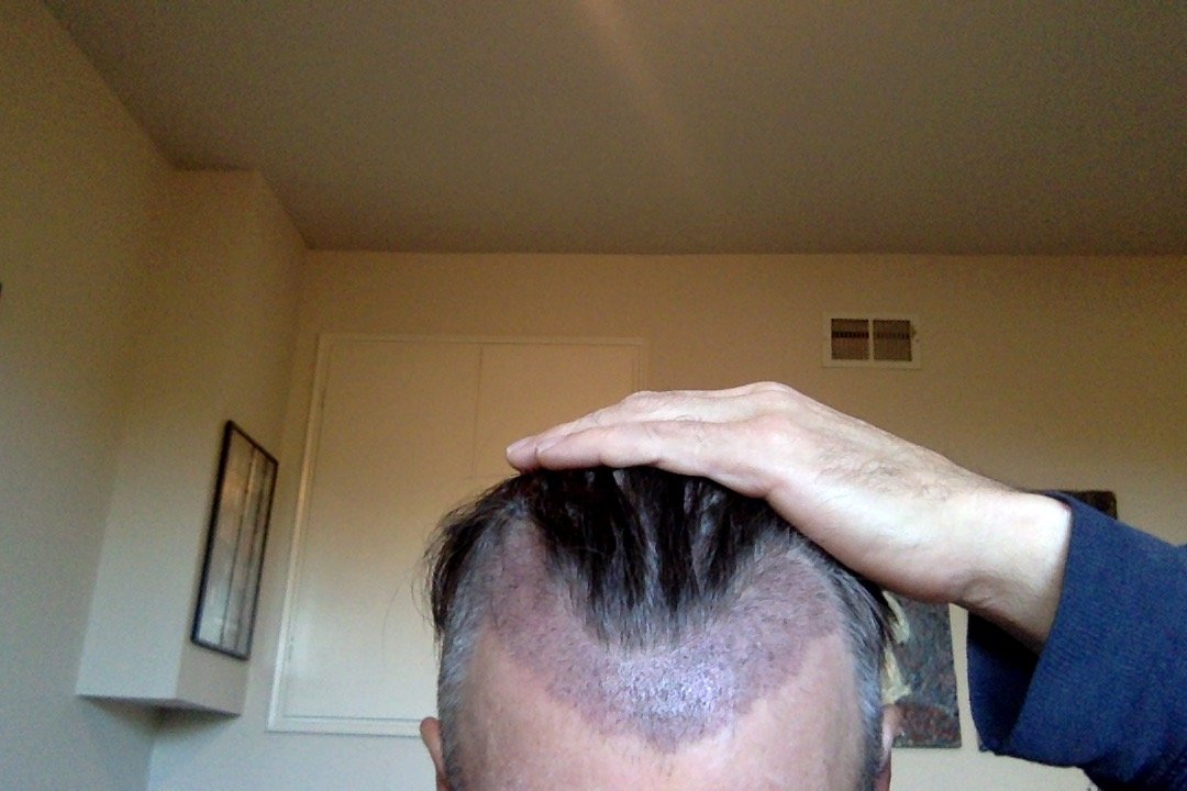 Aloe Vera Redness post Fue - Hair Restoration Questions and Answers - Hair  Restoration Network - Forum For and By Hair Loss Patients