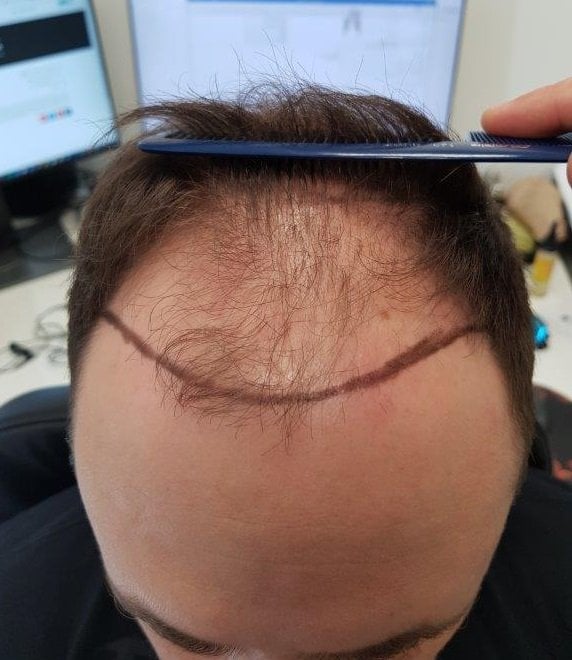 HDC Result of 4180 grafts to front and post op of 2850 to crown – Total 7030 grafts.