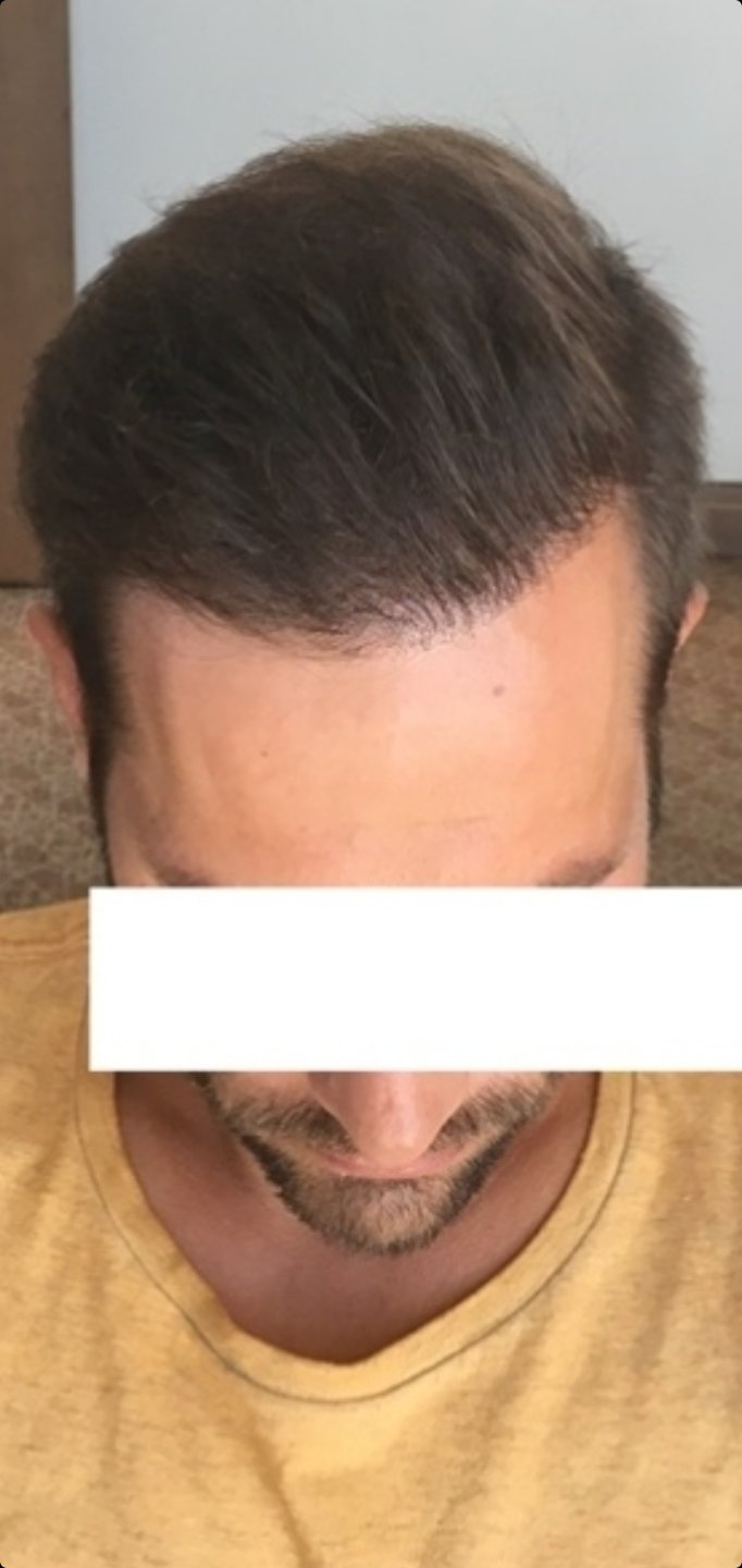 Dr. Maras at HDC clinic in Cyprus, 3000 grafts repair