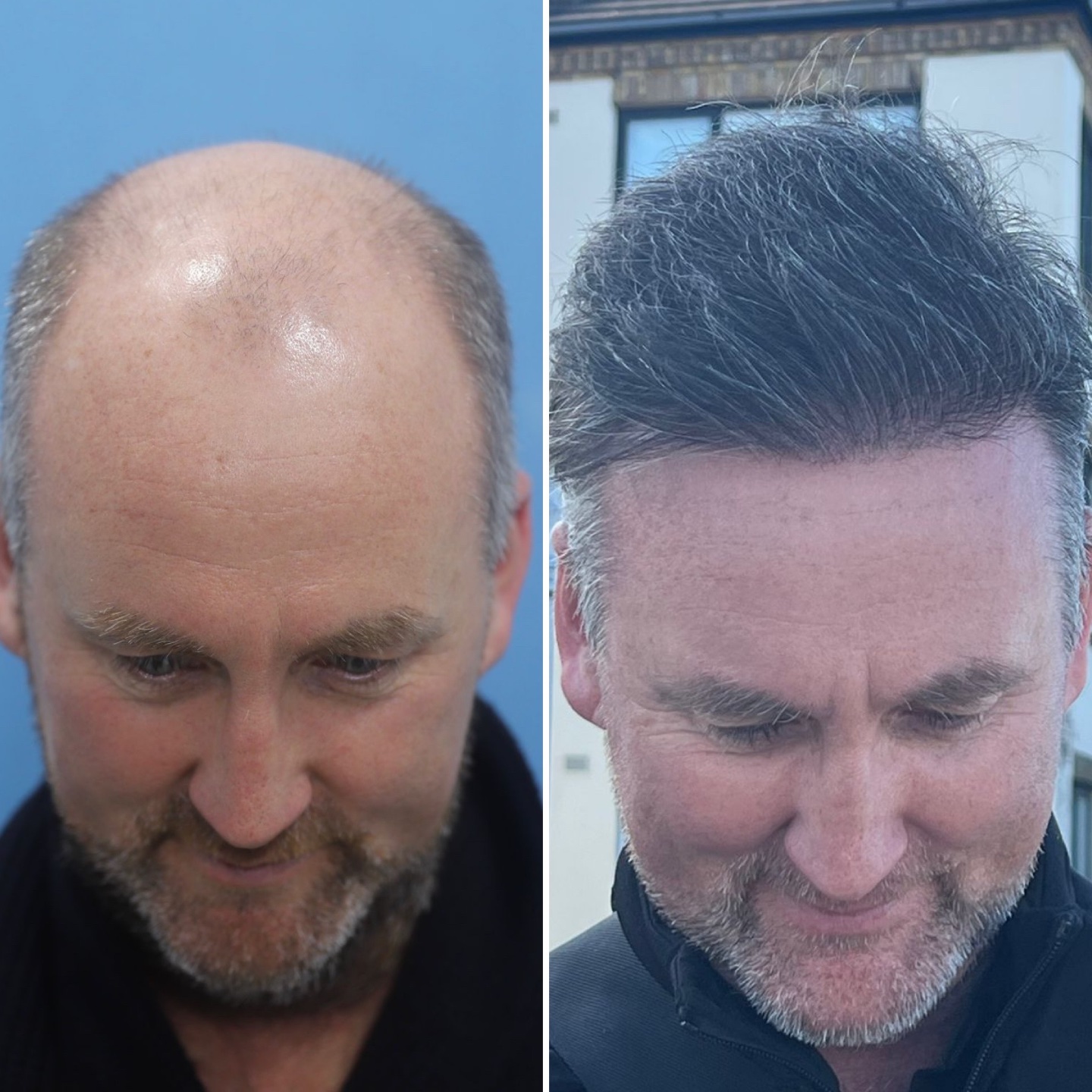 Dave Portnoy Hair Transplant