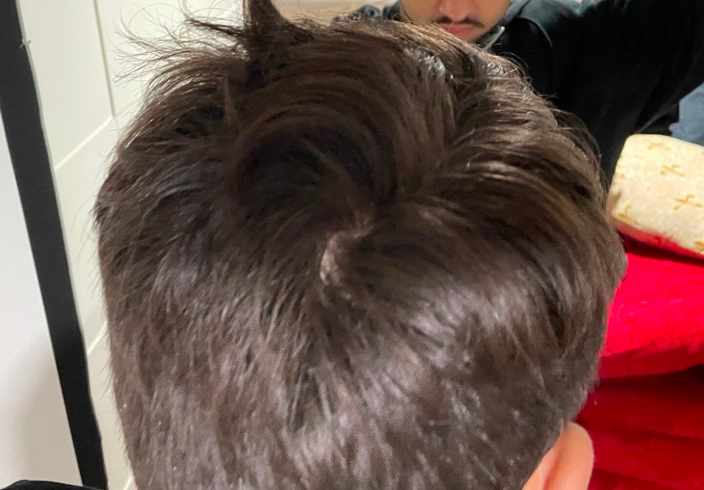 worried-about-crown-after-buzzcut-open-hair-loss-topics-hair