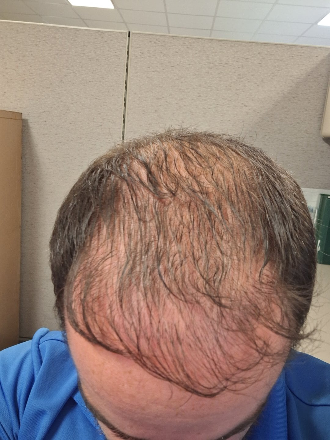 Dr. Ratchathorn Panchaprateep - Verteporfin Hair Transplant 4153 Grafts - Hair Transplant Reviews - Hair Restoration Network - Forum For and By Hair Loss Patients Dr. Ratchathorn Panchaprateep - Verteporfin Hair Transplant 4153 Grafts - Hair Transplant Reviews - Hair Restoration Network - Forum For and By Hair Loss Patients