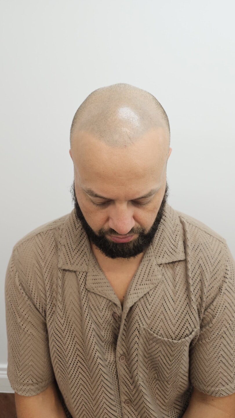 Dr Ruk 9687 Grafts! Two day Mega session
