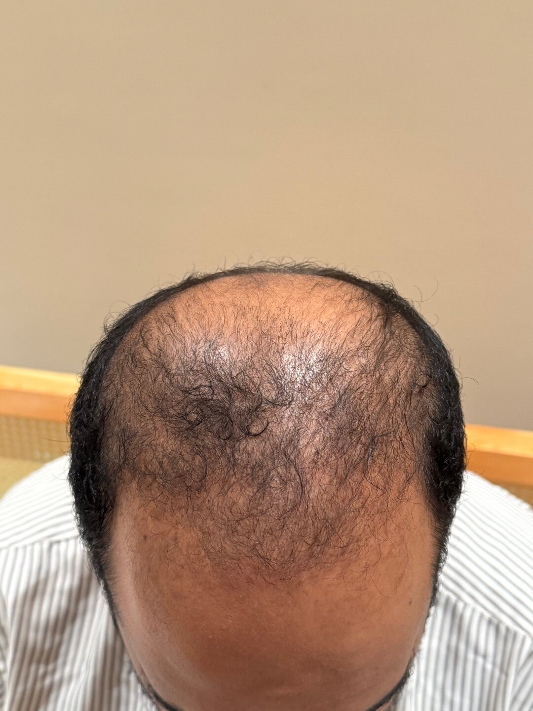 Please help meBest Hair Transplant Clinic in Turkey – Excellent Quality ...