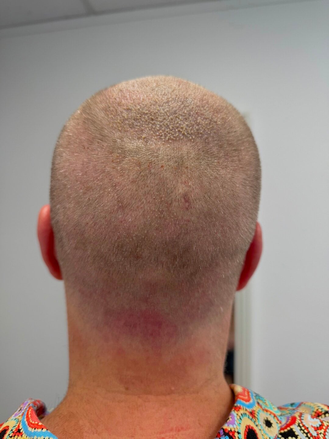 9001 Scalp Grafts 2 days Dr Ruk