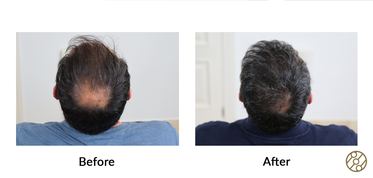Dr. Espinosa Custodio (Spain and Mexico) - 3,856 grafts - FUE/DHI Hair Transplant