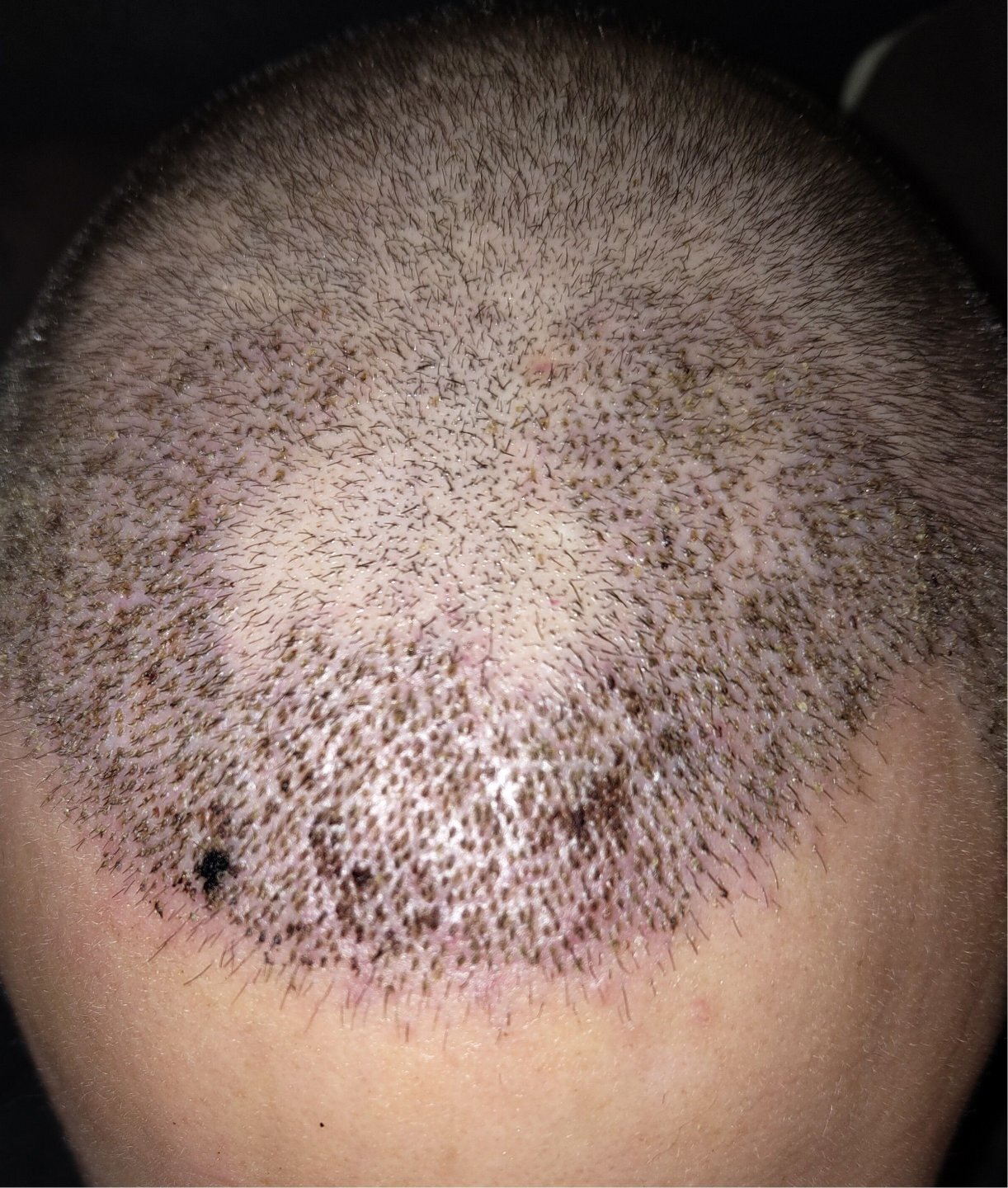 Dr Ted Miln 3500 graft FUE 34/M - Hair Transplant Reviews - Hair ...