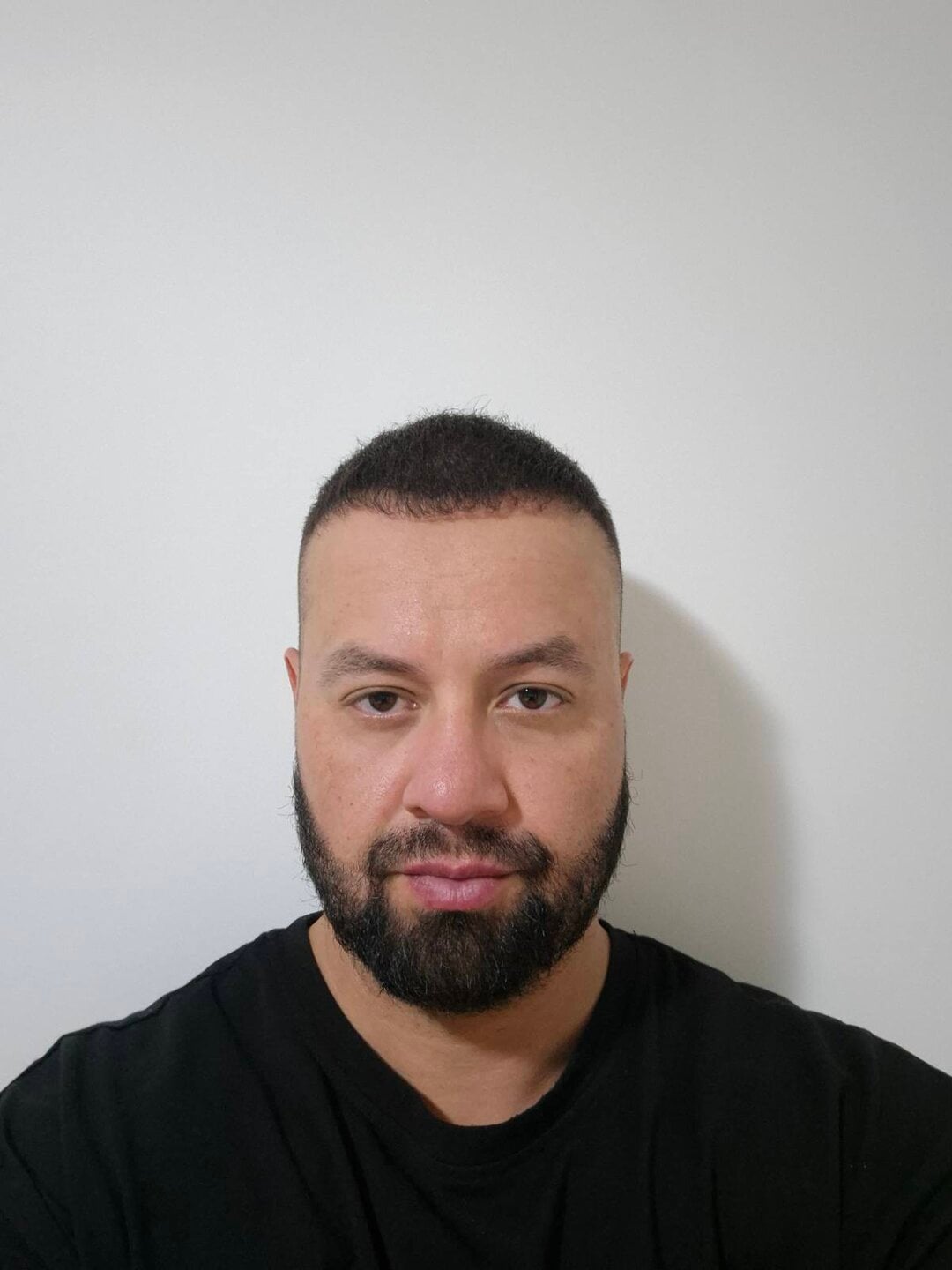 9687 Grafts - Dr Ruk 6 months post - Update!
