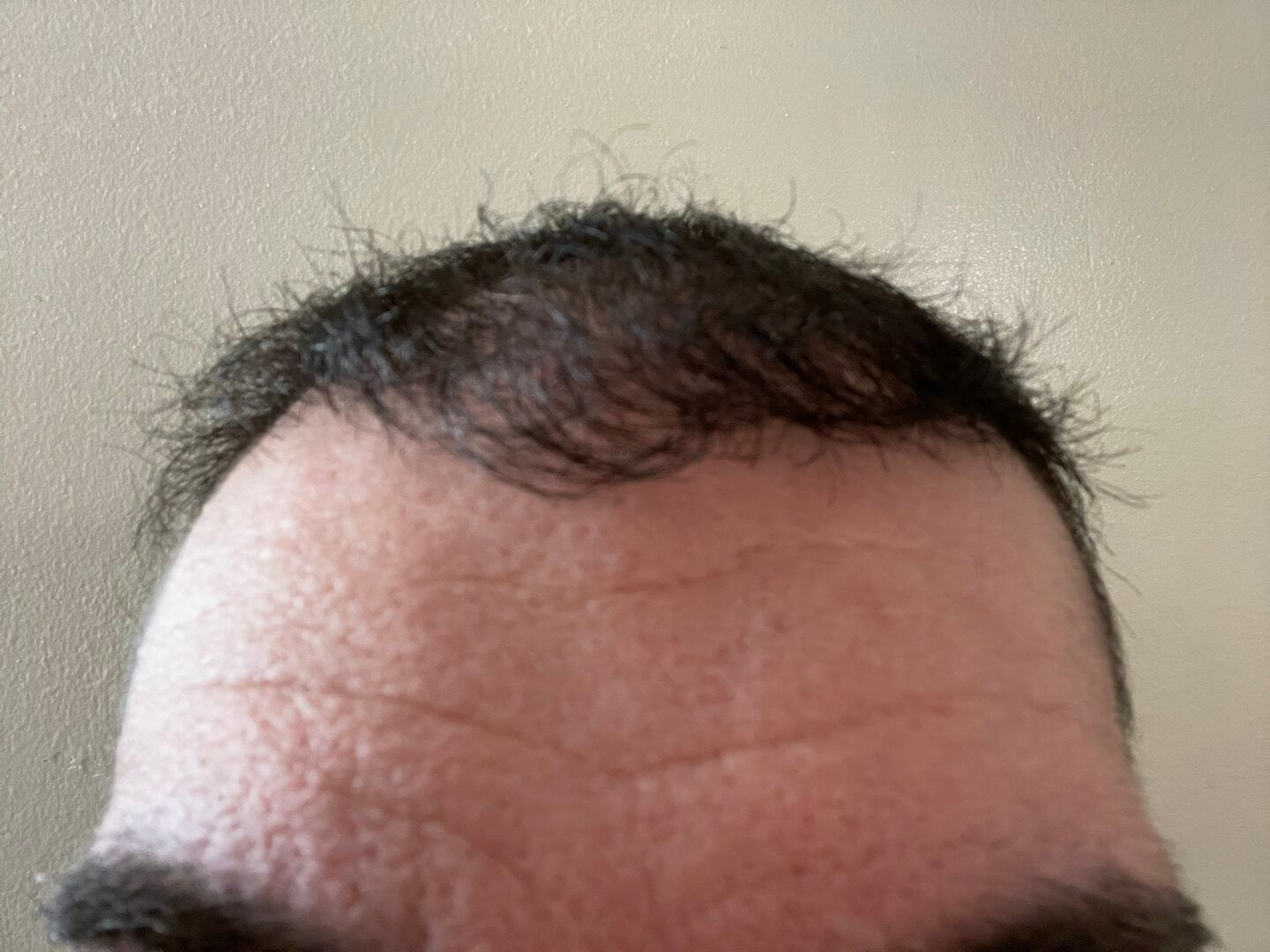 12 month Post Surgery update - 3,086 Follicle Units - Dr. Espinosa Custodio