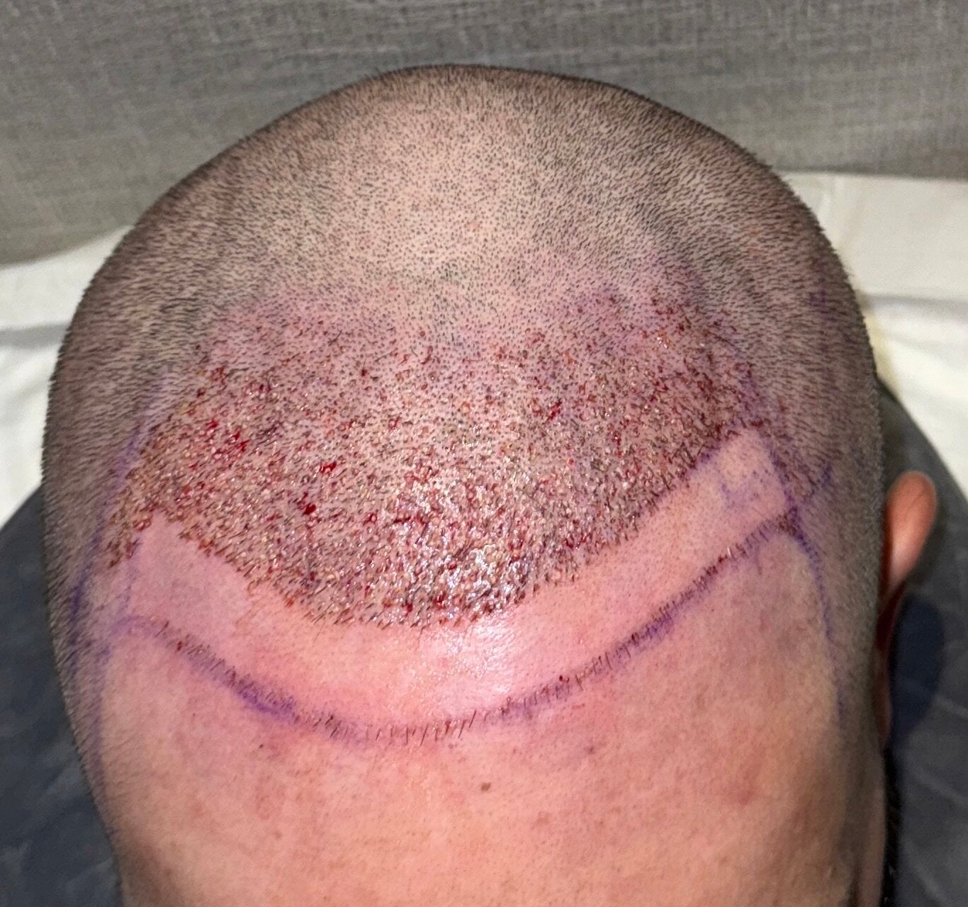 Dr. Espinosa Custodio - 2917 Grafts - DHI -