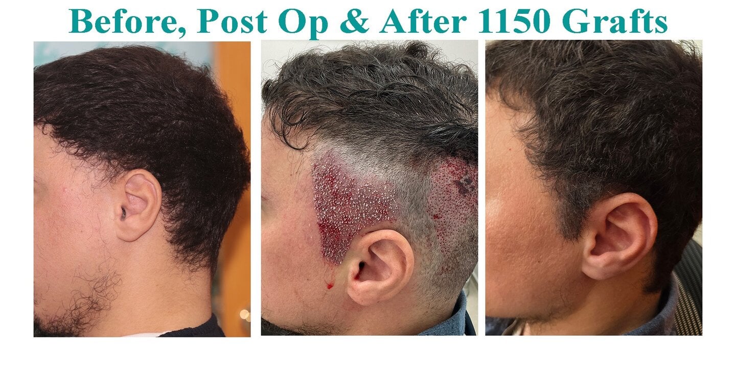 Sideburns, Moustache and Eyebrows Transplant – HDC Hair Clinic (Cyprus)