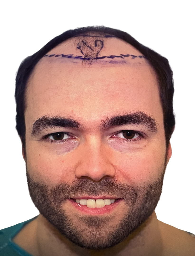 Dr Daniel Ness Video result including SHAVING the result of a 4023 graft transplant for NW5/5a