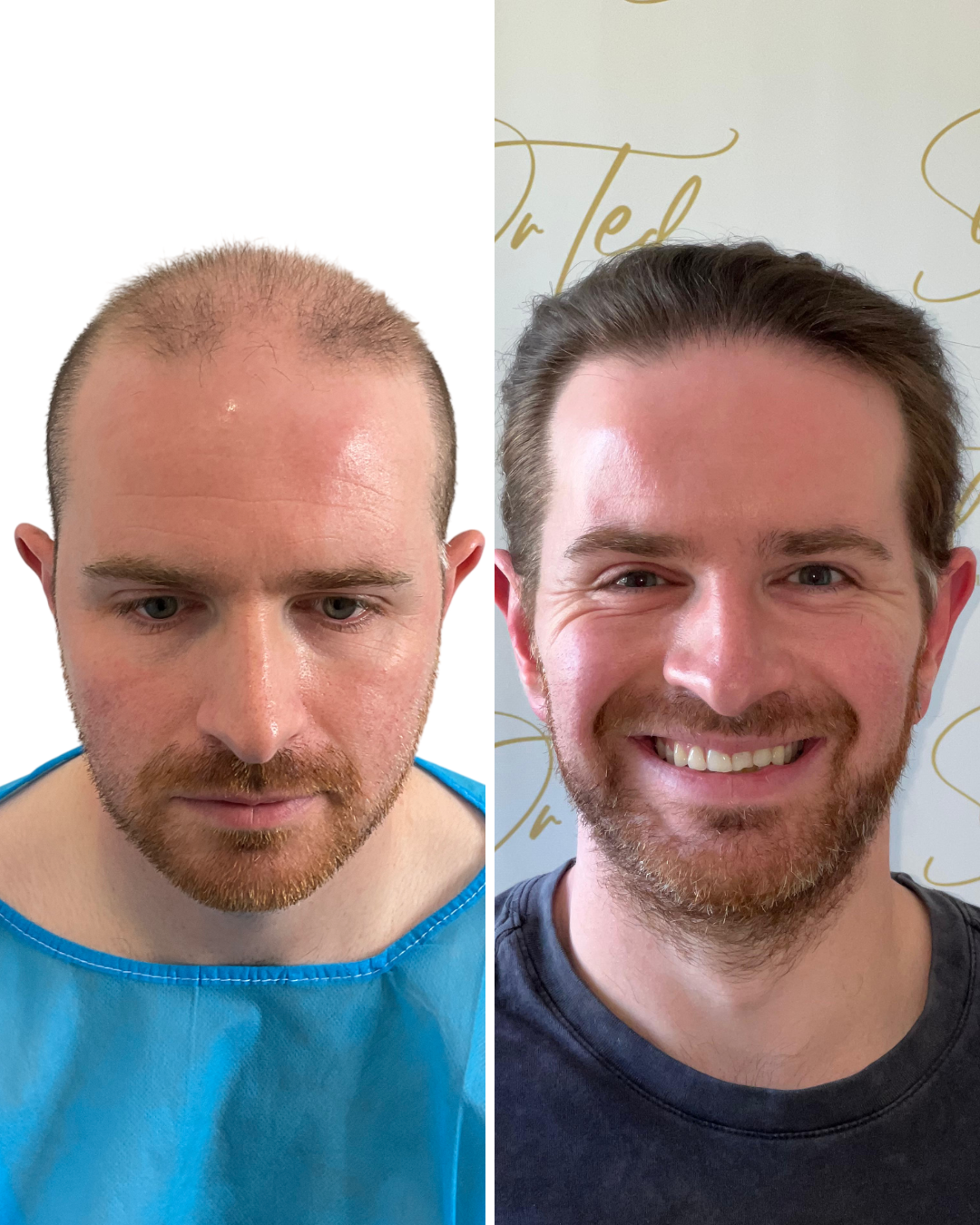 Dr Ted Miln (UK) | 11,734 graft FUT/FUE hybrid surgery | Full NW7 transformation | 3 surgeries + beard hair | Photos + video comb-through