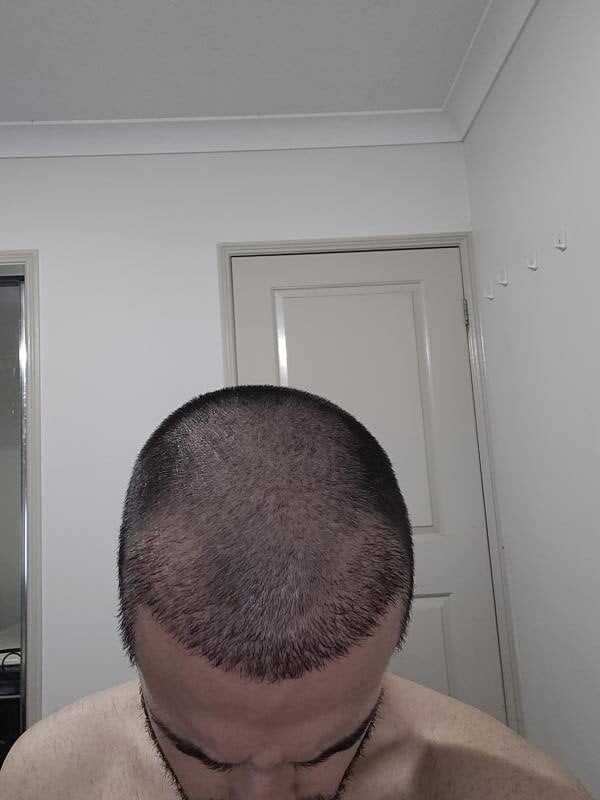 Back From The Dead ---- Expert Advice Graft Removal.
