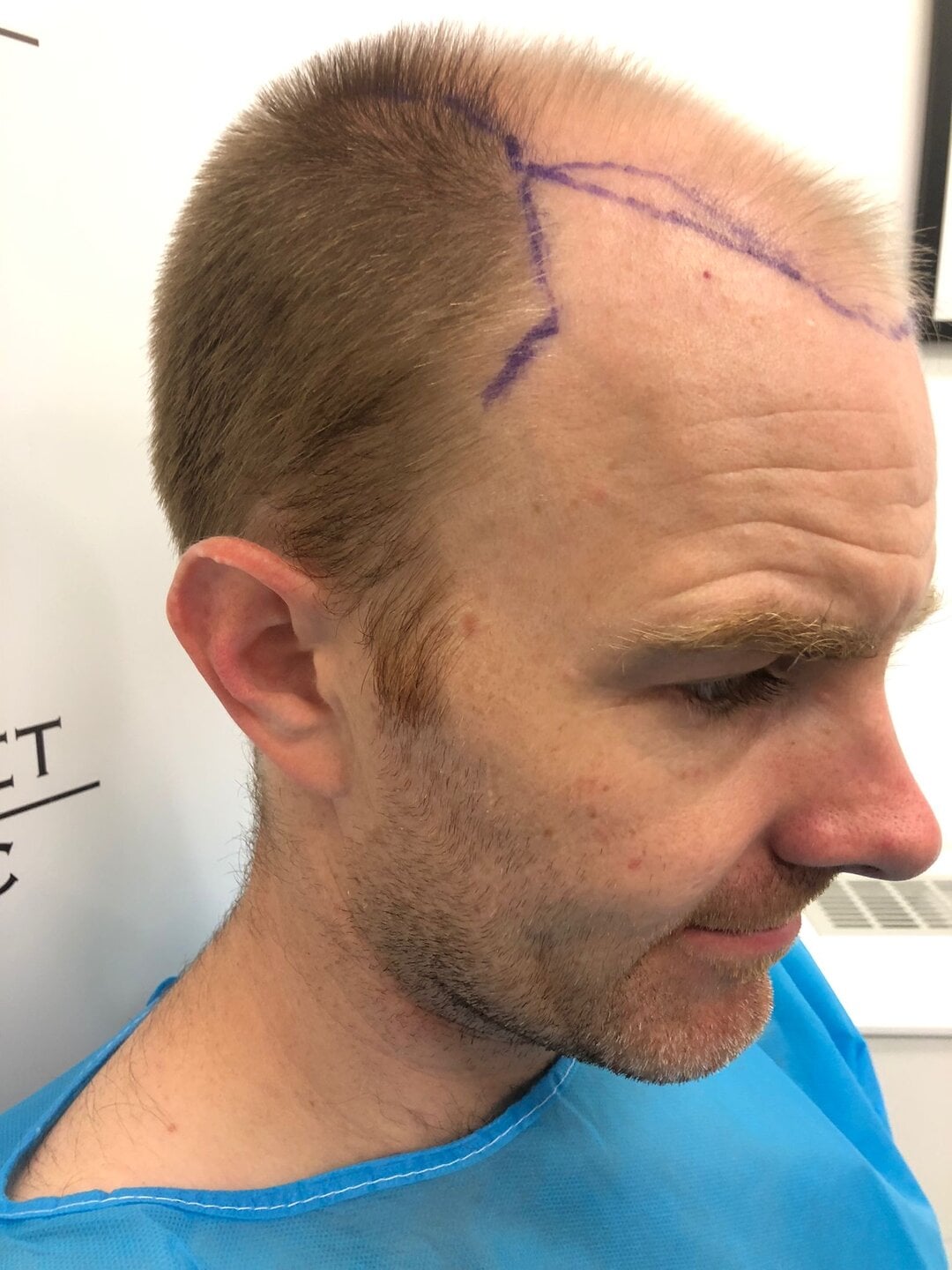 Final 20+ month result for a 4200 graft single session transplant for NWVa patient - video result in full sun