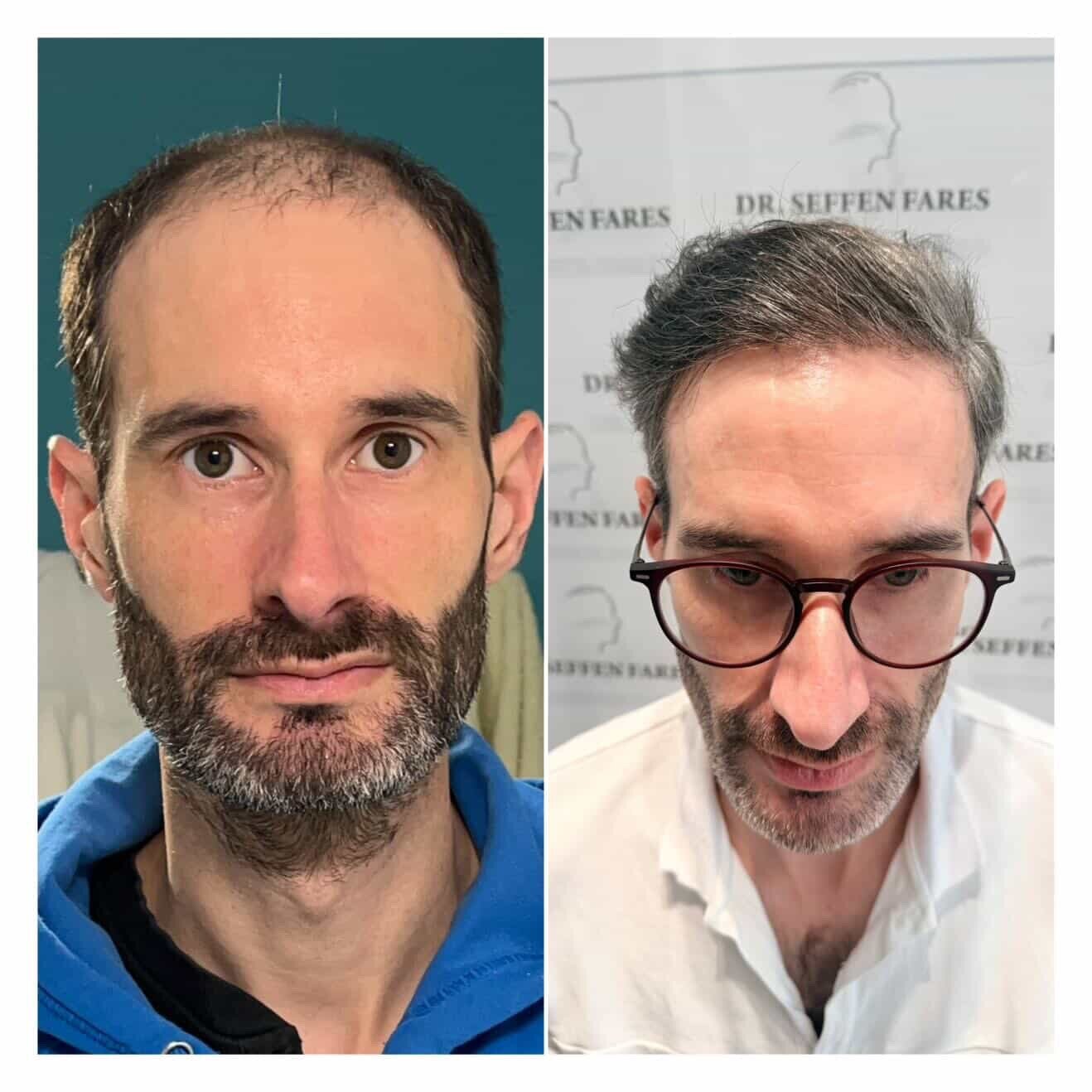 Dr Fares Seffen (Tunis, Tunisia)  , NW 6 , 4112 FUE results Day 0 --> 12 Months after