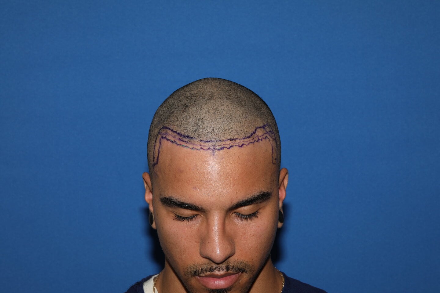 Afro FUE Hair Transplant – 1,550 Grafts | 7-Month Result | Dr. Bhumik Shah | New Jersey & Philadelphia