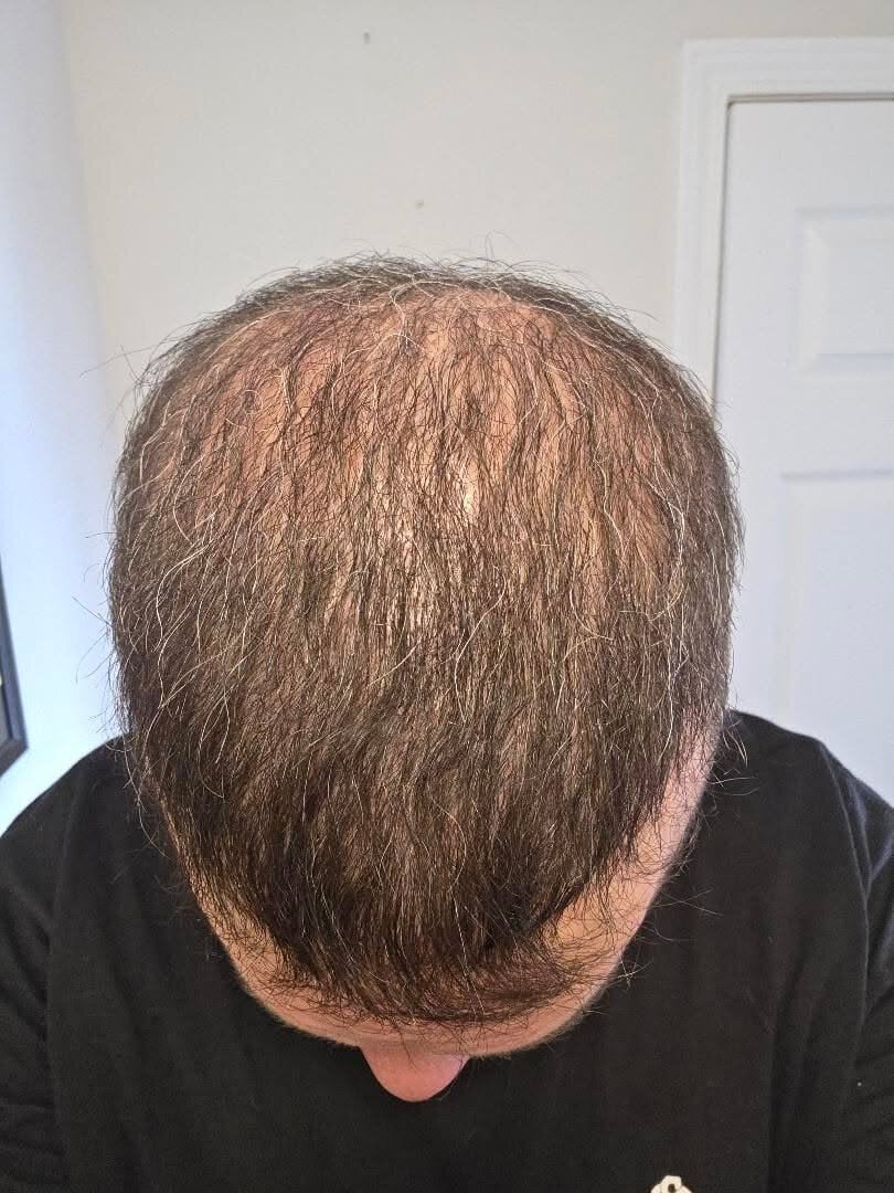 11661 Grafts - Dr Ruk