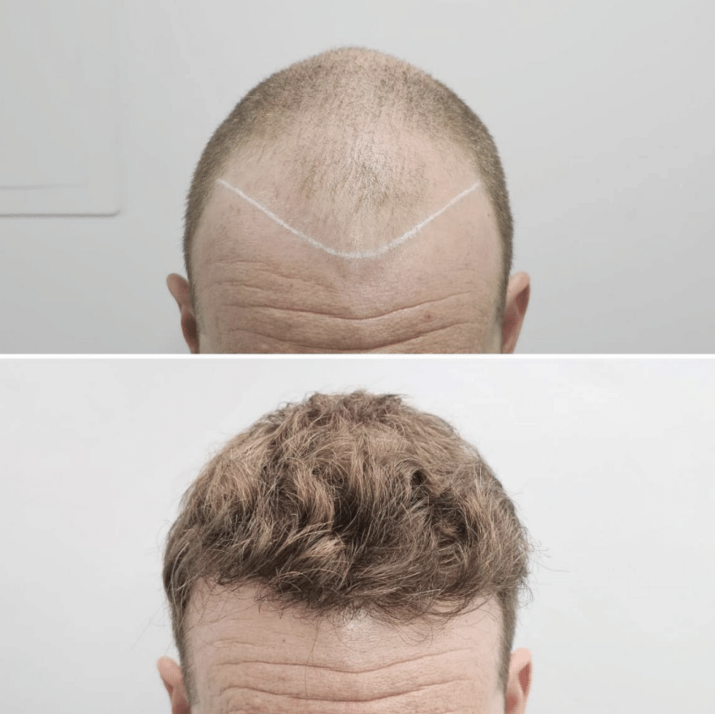 The Treatment Rooms, London | Dr Fernando | 3800 FUE Grafts | Frontal & Crown Restoration (2 Procedures)