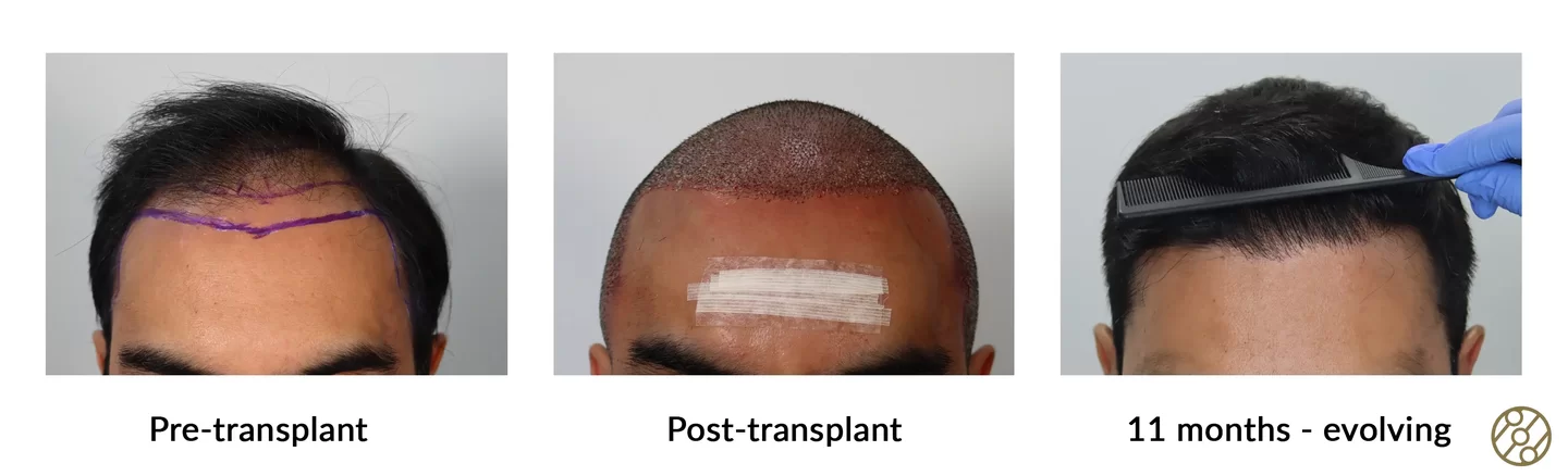 Dr. Espinosa Custodio (Spain and Mexico) - 3,156 grafts - FUE/DHI